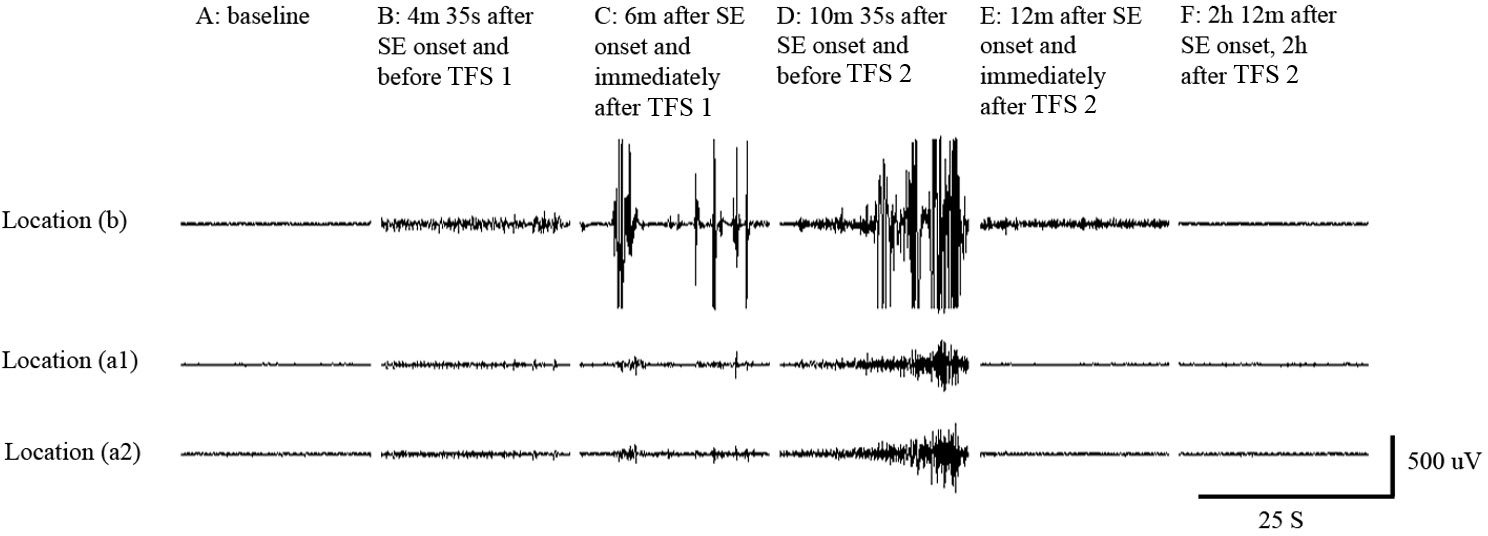 TFS via TCREs abolished pilocarpine induced status epilepticus (SE)