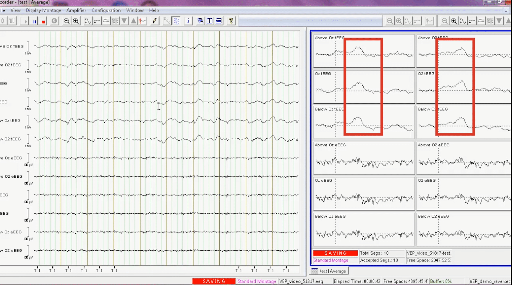 VEP response seen in tEEG after averaging only 10 segments around the trigger. Peaks not seen in eEEG below.